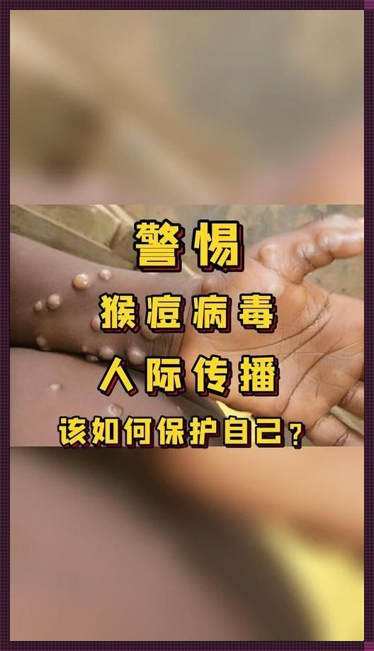 探寻猴痘病毒治疗最优方案：守护健康，共克时艰