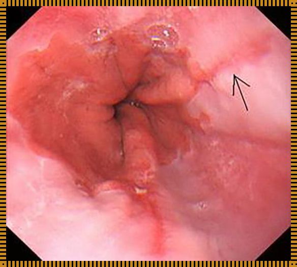 如何判断自己得了食道炎？