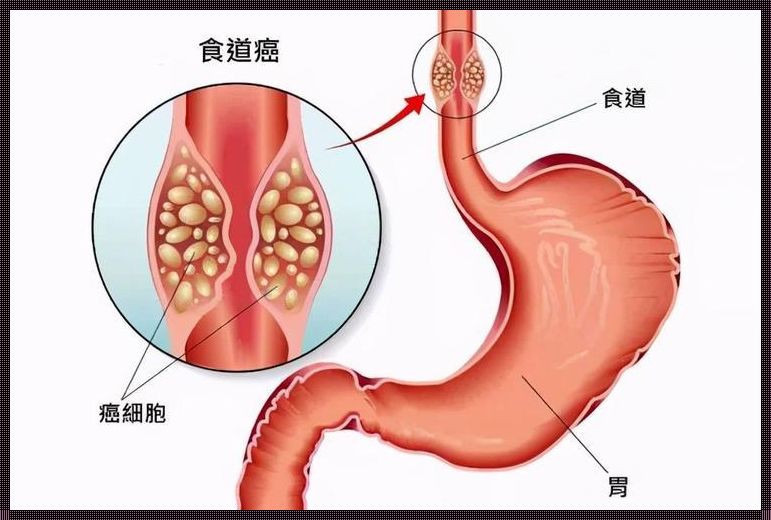 的老人食道肿瘤治疗之道：希望之光照耀暮年