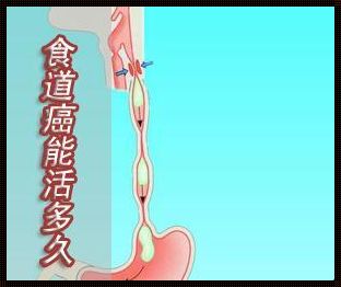 食道肿瘤：“惊现”生命延续之光