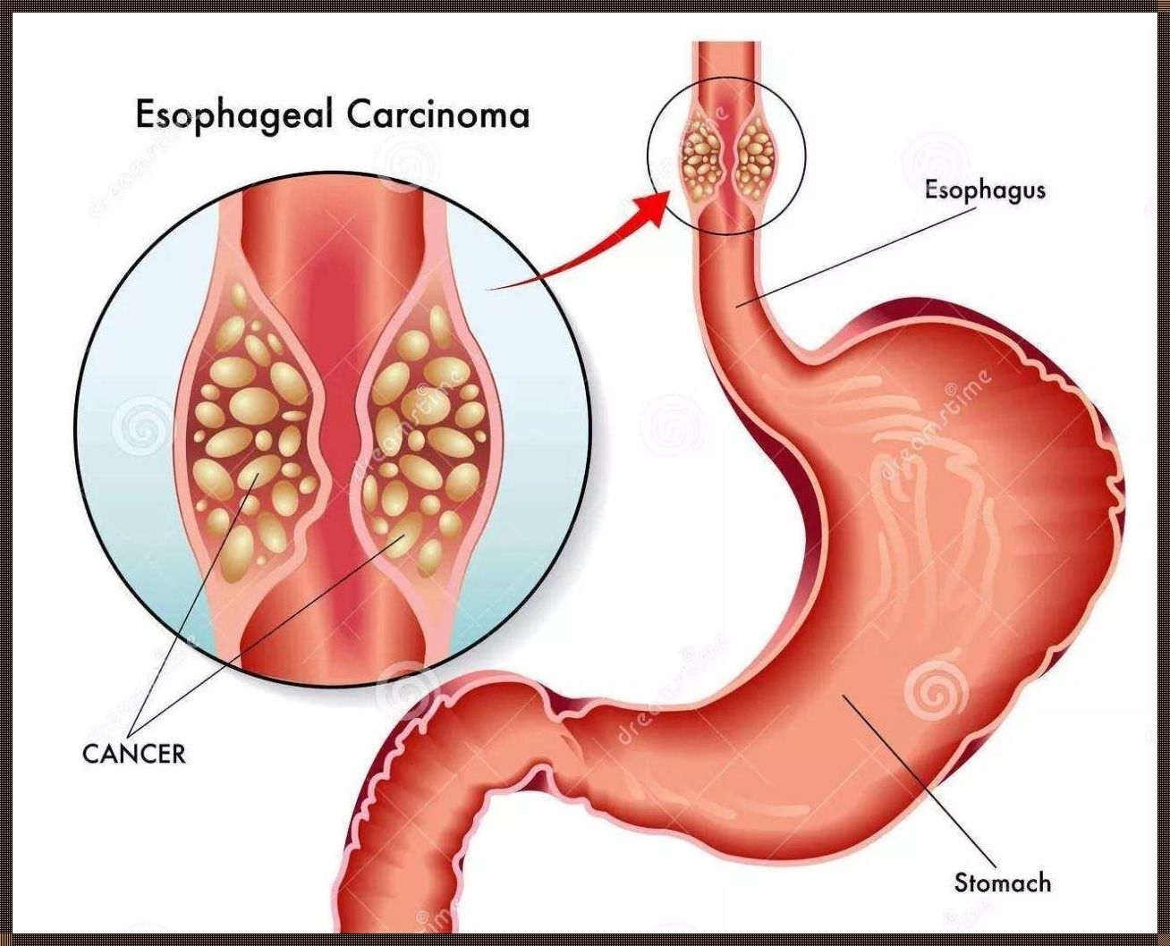 食管癌早期的 15 个警示信号