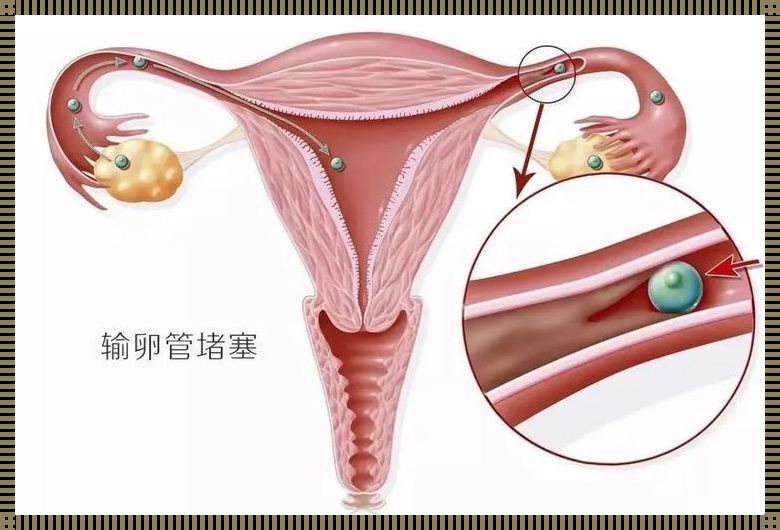 输卵管堵塞诊治之道：探寻女性生育的希望之光