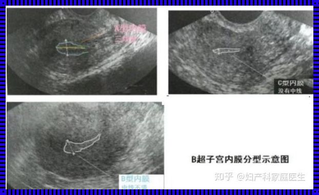 广安内膜薄宫腔灌注疗程探究