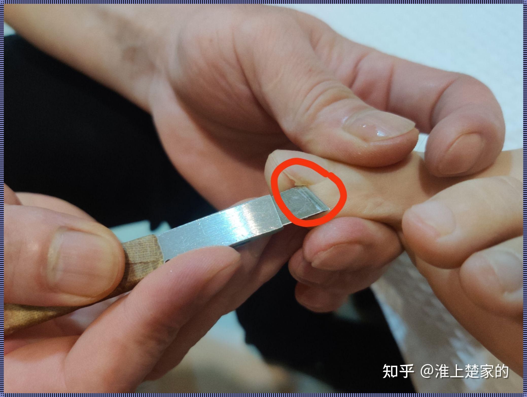 甲沟炎手术费用揭秘：金钱与健康的权衡