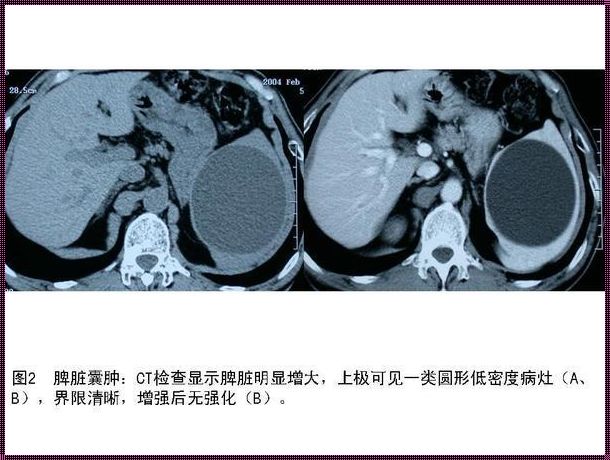 面对脾上肿瘤：科学的力量与生命的坚韧