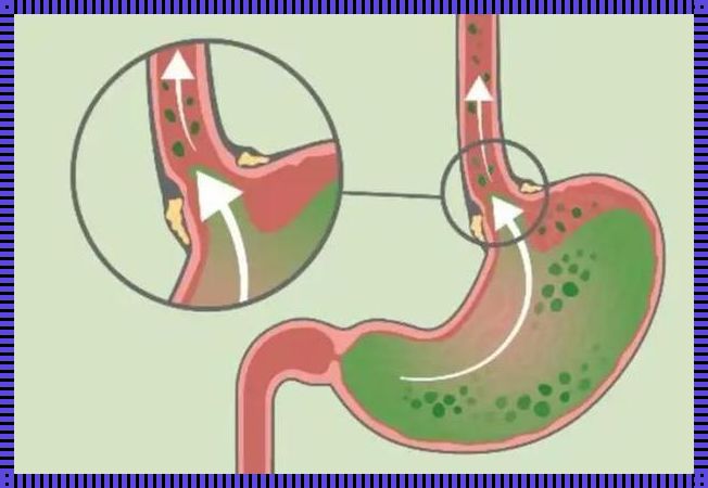 《反流性食管炎患者为何会感到鼻子像呛水？》
