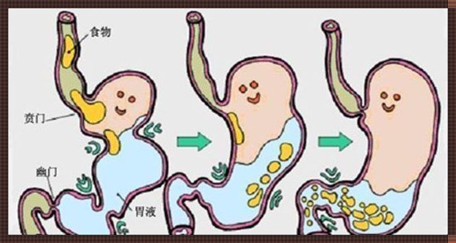 破解胃酸反流难题：一步到位的解决策略