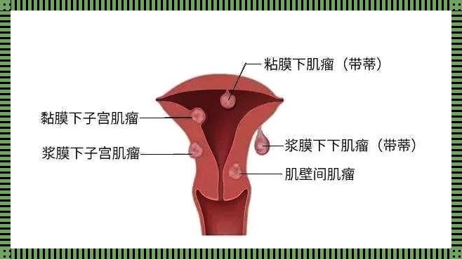 震惊！子宫肌瘤转变成癌的前兆揭秘