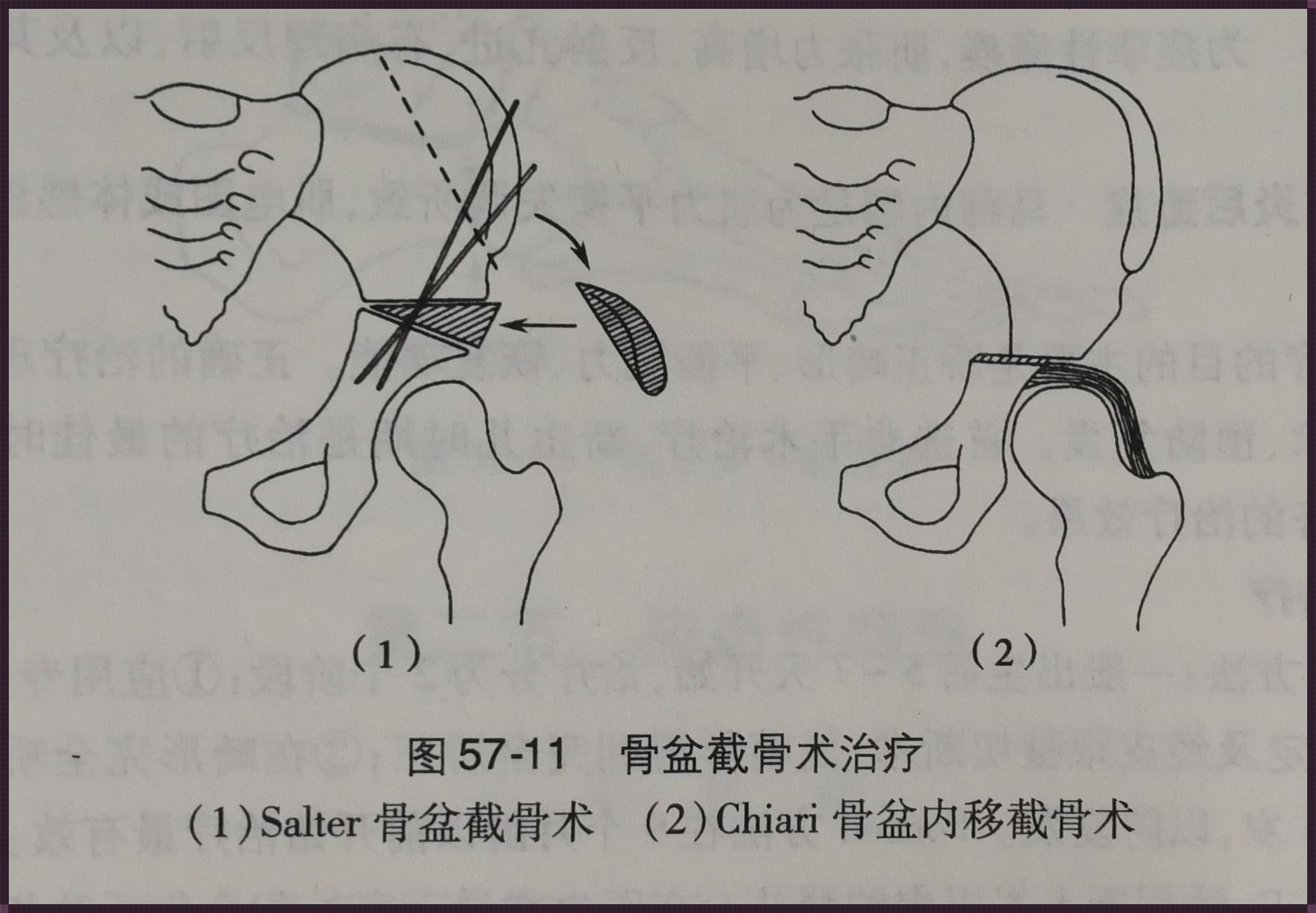 髋关节错位是否需手术治疗？