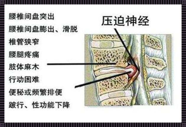 腰突压迫神经2个月康复之路——我的亲身经历