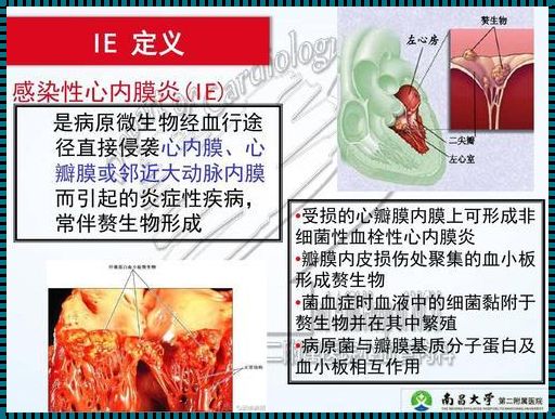 结核性心内膜炎的症状解析