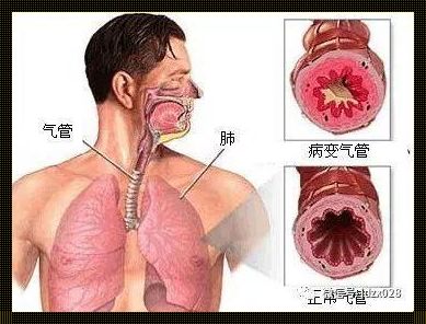 如何判断是否患有气管炎