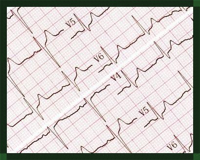 心电图波动大好还是小好——我的亲身经历