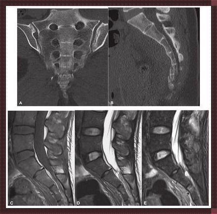 骶髂关节检查：CT 与磁共振，如何抉择？