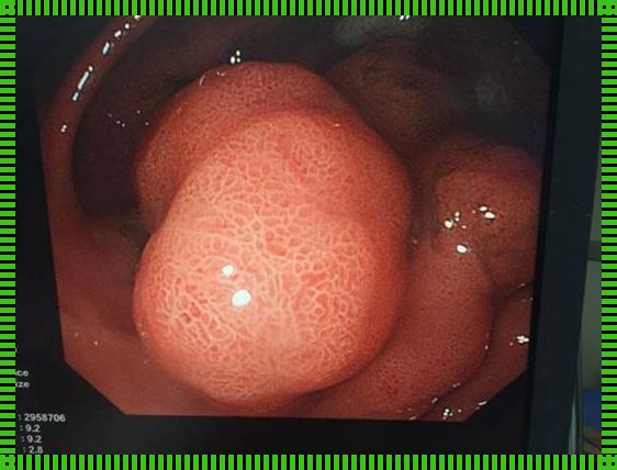 食道炎最明显饱腹症状：惊现与科学对策