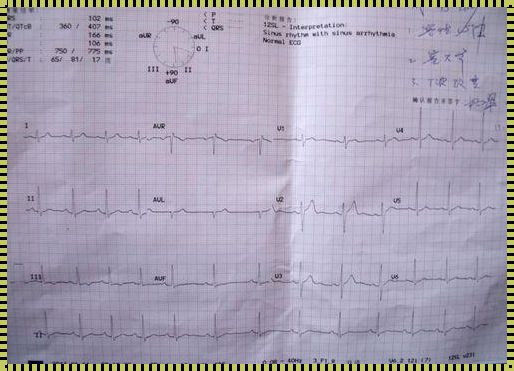 T波改变：是健康危机吗？