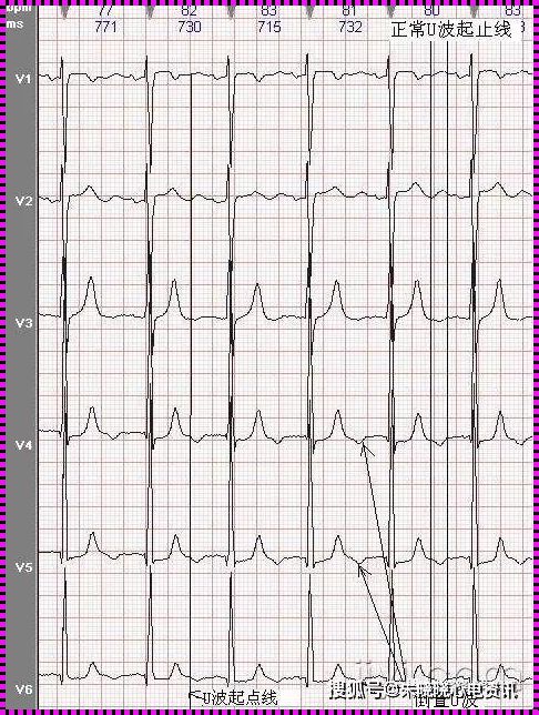 T波改变：是健康危机吗？