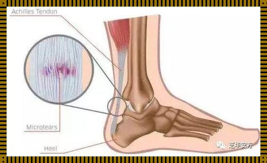 跟腱炎怎么治好的快