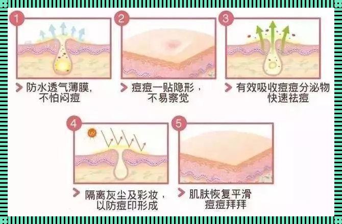 祛痘产品原理：从根源击退痘痘