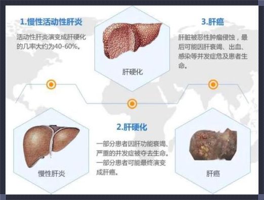 肝硬化失代偿活了30年：一个生命的坚韧与奇迹