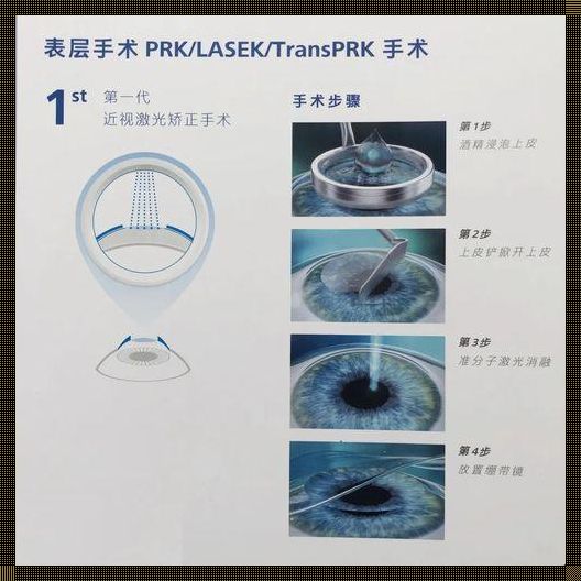 全飞秒和ICL哪个更安全：一个主观且别开生面的盘点