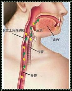 食管炎不反酸就是喉咙堵——揭秘身体信号背后的真相