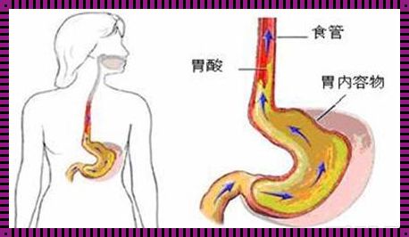 情绪好了，反流性食管炎会好吗？——我的真实经历与感悟