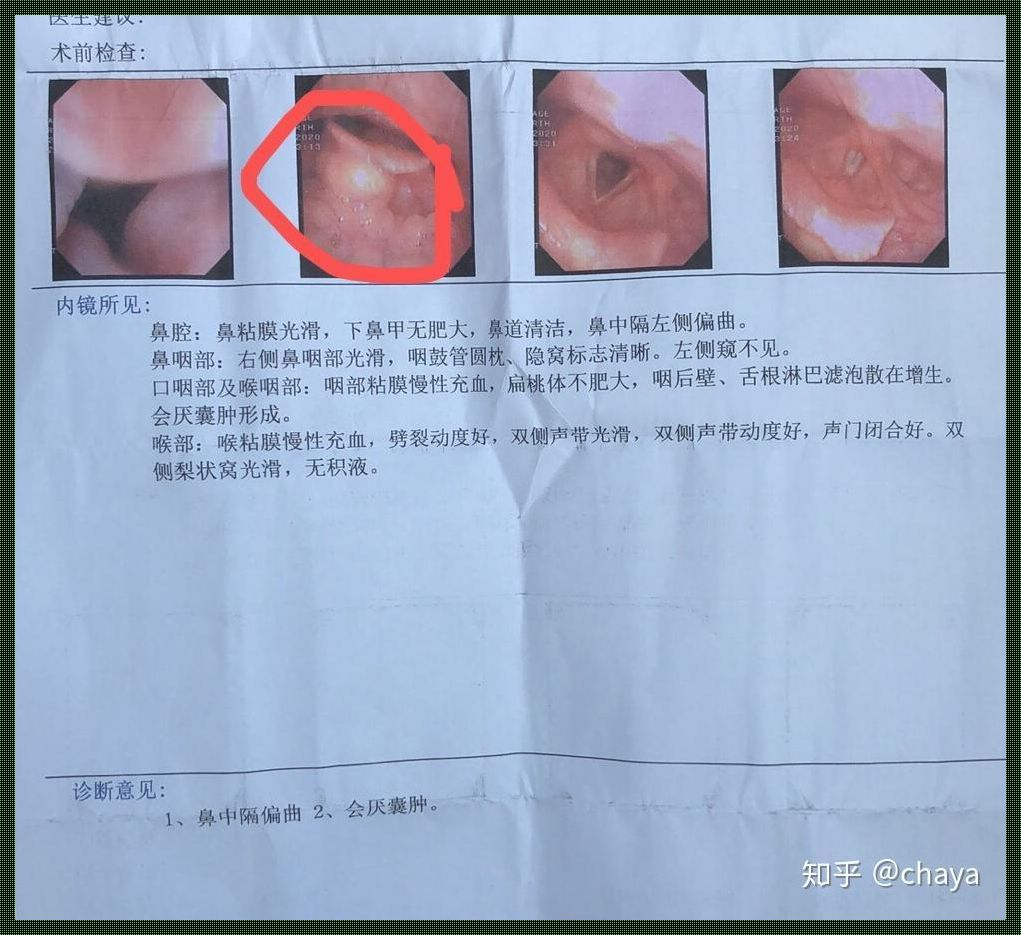 会厌囊肿：CT 检查的必要性