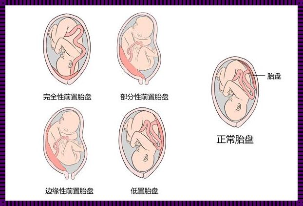 边缘性前置胎盘：危险大吗？