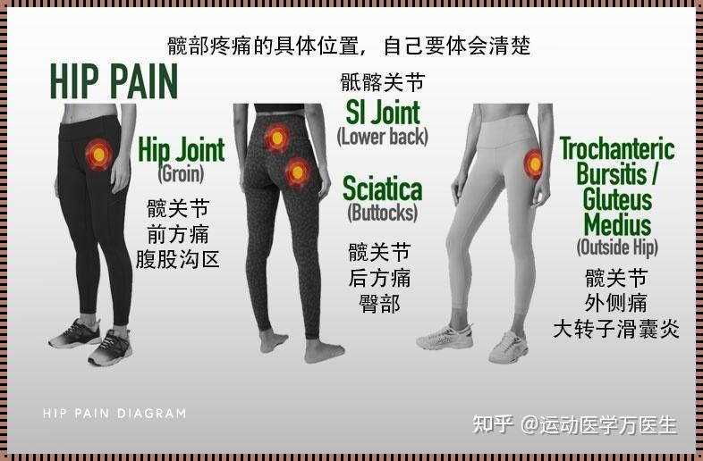 髋关节酸痛的主要原因及应对策略