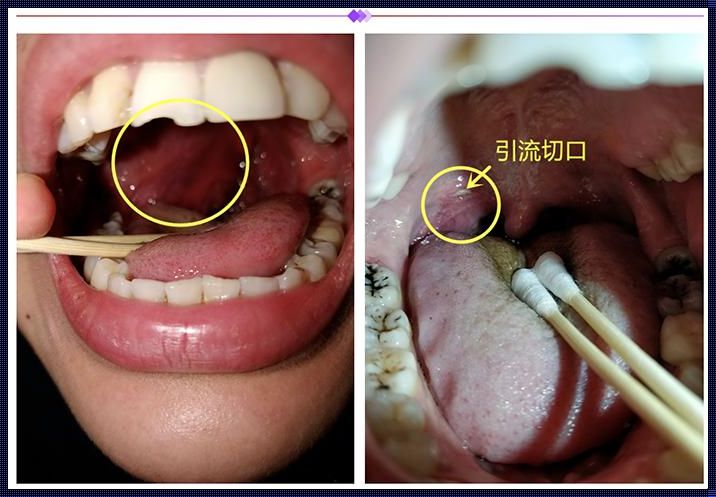 面对扁桃体化脓 棉签难以取下的困境