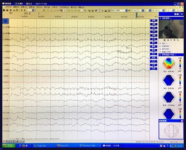 新生儿脑电波检查：有必要吗？