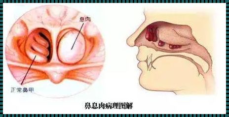 儿童鼻息肉最佳治疗年龄：关爱孩子的呼吸健康