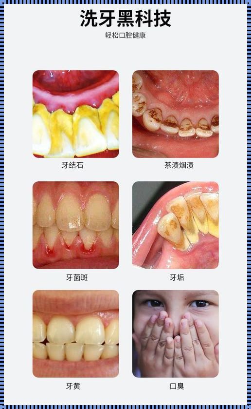 牙结石怎么自己去除：爱牙护齿，从“齿”开始