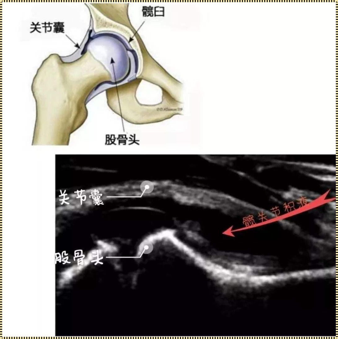 髋关节滑膜炎的症状解析：探秘疼痛背后的故事