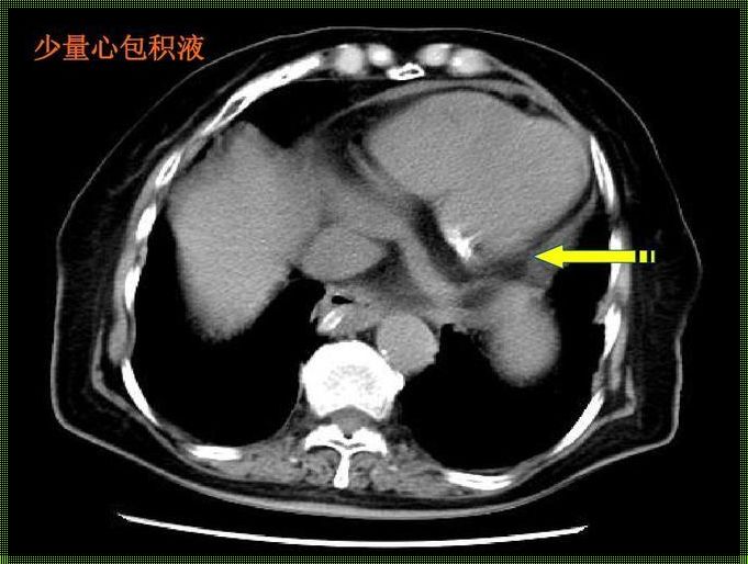 心膜积水：揭秘心脏的微妙信号