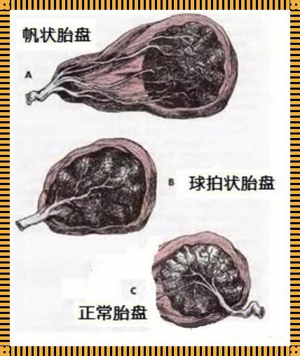 球拍状胎盘多躺还是坐：探索最佳姿势