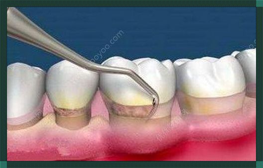 三个小偏方治疗牙周炎