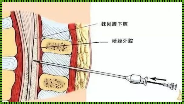 骨折手术选择全麻还是半麻？生态视角下的思考