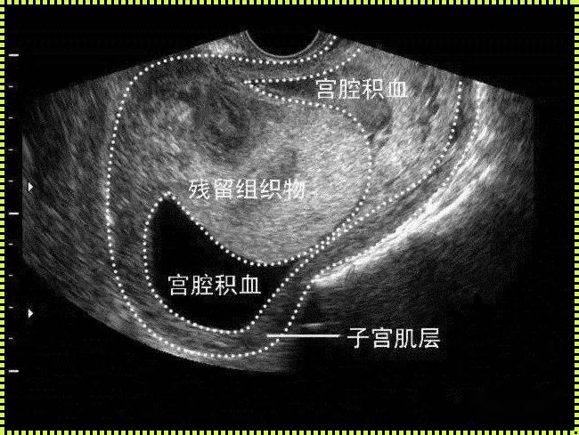 宫腔内5mm暗区是孕囊吗？揭秘背后的故事