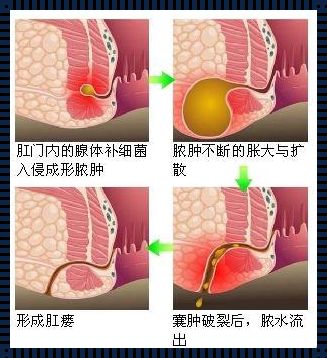 肛周硬块一定是脓肿吗？深度解析带你走出误区