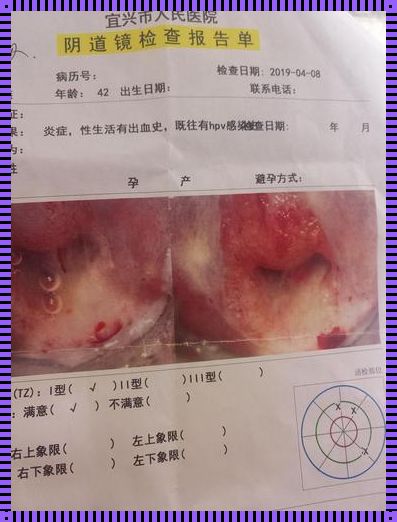 宫颈管里长息肉严重吗？——深入解析带你走出恐慌