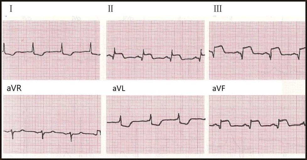 心梗心电图：震惊的真相