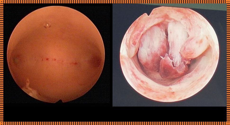 子宫内膜息肉八年后复发：一位患者的真实经历