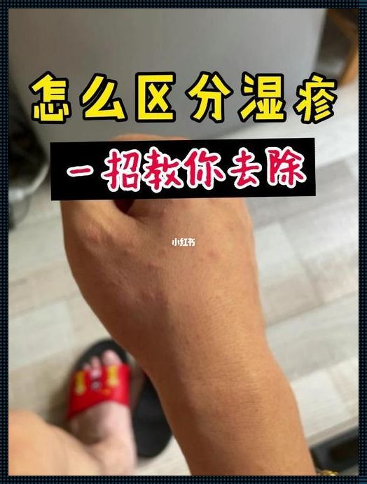 为什么会突然长湿疹