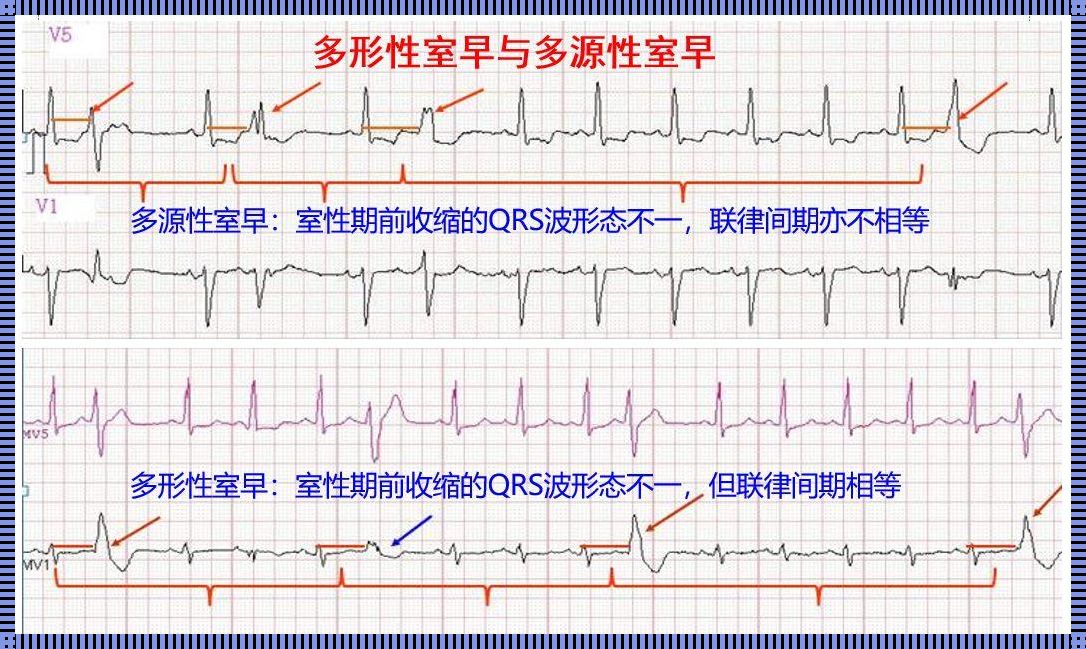 小孩频发室性早搏严重吗？