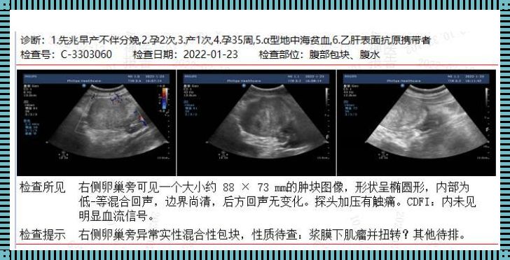 孕八周有褐色分泌物无腹痛：褐色分泌物的秘密