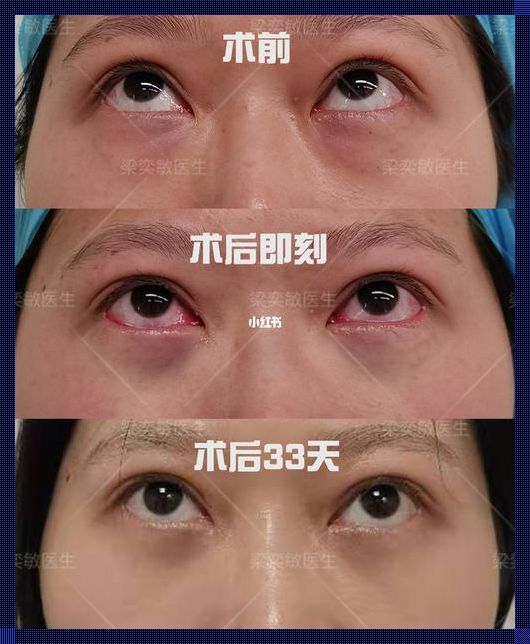 眼袋切后还长吗？揭秘眼袋手术的真相