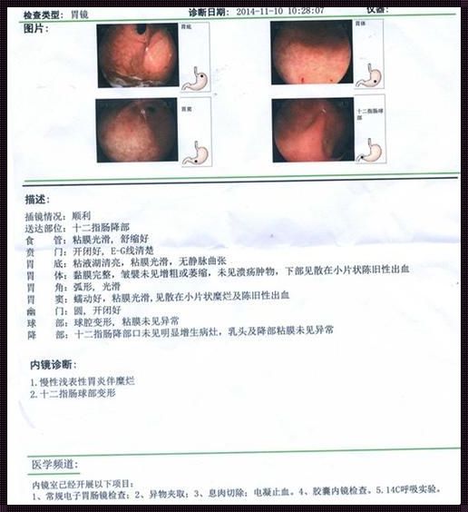 慢性胃炎能否检查出来？