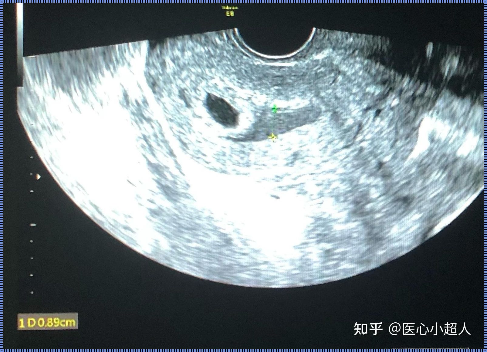 妊娠囊周边积血：关注与解析